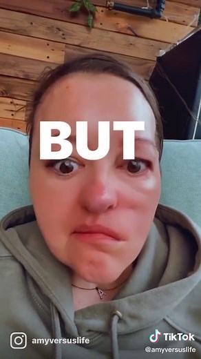 Brain tumour removal surgery, the first year after. #braintumoursurgery #braintumourjourney #braintumoursurvivor #braintumourstitchesremoval #braintumourssuck #braintumorsurvivor #braintumorsurgery #braintumorfighter #nf2 #neurofibromatosis #neurofibromatosistype2 #spoonielife #spoonietiktoks #spooniesoftiktok #tumourpatient #tumoursurgery