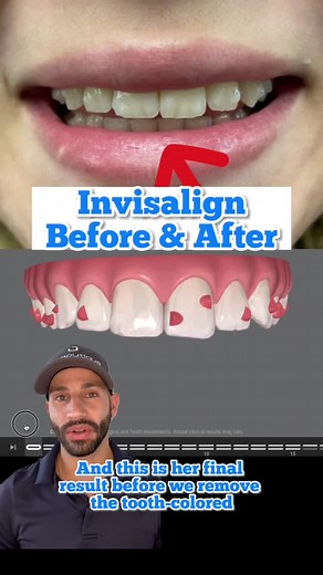 Invisalign before and after, and the difference between simulated versus actual appearance of attachments. #orthodontist #orthodontics #orthodontistsoftiktok #invisalign #invisaligndoctor #fortlauderdale #fortlauderdaleorthodontist #fortlauderdaleinvisalign