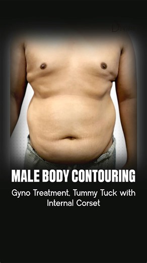 Male Chest and Abdomen Transformation #gynecomastia #tummytuck #plasticsurgery