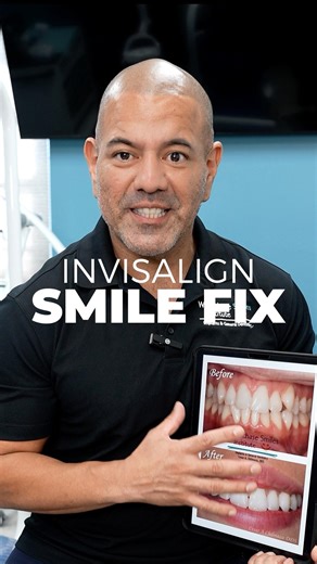 🔎 Invisalign Case Study #Invisalign #SmileCare #CosmeticDentistry