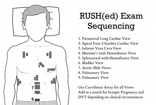 Rapid Ultrasound for Shock and Hypotension - the RUSH Exam
