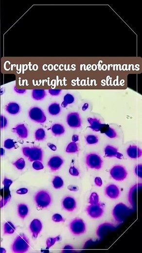 Cryptococcus neoformans | A case of cryptococcal meningitis