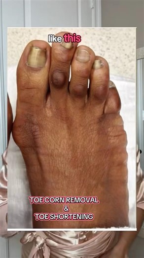 TOE CORNS and TOE SHORTENING