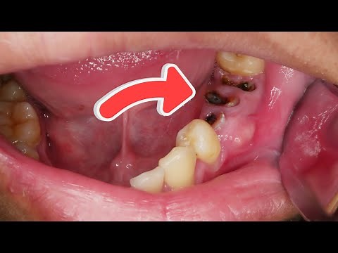 Ini Harus Dicabut dan Diganti Dengan Gigi Palsu | Tooth Extraction | Dentist | Dokter Gigi Tri Putra