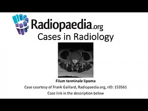 Filum terminale lipoma (Radiopaedia.org) Cases in Radiology