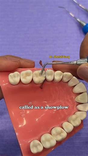 Dr Shefali Garg | MDS || Dental Educator | on Instagram: "YOU DEMAND, I DELIVER Snowplow technique us a great way to restore Class II cavities without voids and proximal overhangs. Dm/comment a topic you want video on. Save this reel and follow for more 🦋 #dental #dentist #mds #bds #tooth #rct #rootcanaltreatment #dentistry #chandigarh #dentaleducation #dentalcollege #dentalschool #postgraduate #clinician #research #viralreels #dentalreels #comtentcreator #educator (Dentist, dental, dentistry,