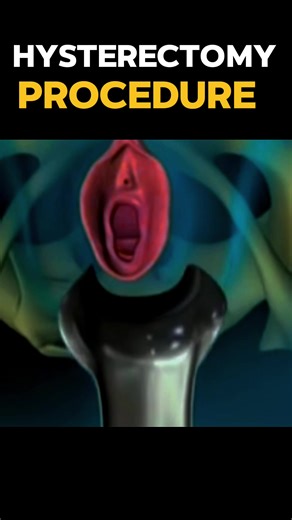 Hysterectomy Surgery: Types, Procedures, and Recovery