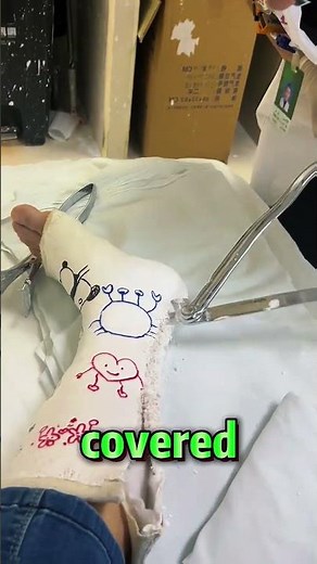 Cut open the plaster cast that had been worn for a long time