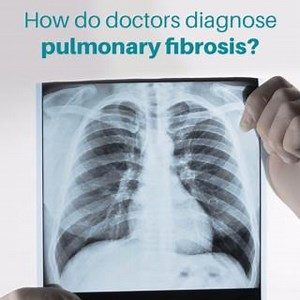 1.2K views · 17 reactions | How do doctors diagnose interstitial lung disease? In our latest webinar, "Diagnosing ILD: Elements of a Comprehensive Evaluation," Drs. Amy Hajari Case and Stephen Hobbs dive into all the ways doctors evaluate cases of pulmonary fibrosis. View the full length feature at https://youtu.be/4d0C8cPfPFo | Pulmonary Fibrosis Foundation | Facebook