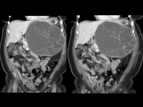 CT of the Adrenal Gland: A Pattern Approach Part 1