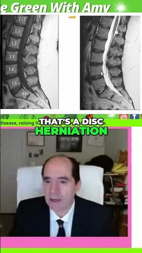 MRI Explained: T1 vs T2 Sequences & Spotting Disc Herniation! #shorts