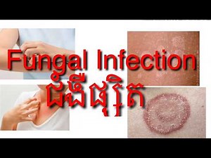 ជំងឺផ្សិតស្បែក​ នឹងការព្យាបាលដោយប្រេីថ្នាំ​ Fungal Infection And Treatment By Drug