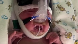 4.6K views · 99 reactions | Baby Jessica was born premature at 1 lb....
