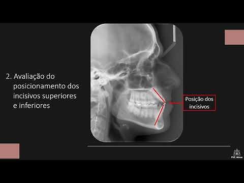 Gota #159 EXAMES DE IMAGEM NA ORTODONTIA: Telerradiografia Lateral
