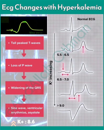 ⚠️ Hyperkalemia: ECG Essentials 🚨 Core Progression: Peaked T-waves→ Loss of P-waves → QRS widening → Sine Wave → VF/Asystole ✔️ · Flattened P Wave: Impaired atrial depolarization · Widened QRS: Delayed ventricular depolarization · Sine Wave: Pre-arrest emergency ⚡ Requires immediate calcium stabilization& potassium reduction #Hyperkalemia #MedEd #CriticalCare #Cardiology #ECG #FOAMed --- Save 📌 | Share 🔗 | Tag a colleague! #hearthealth | Abdallah Othman
