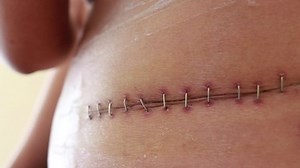 clip-1068898829-close-up-surgical-incisions-abdomen-using-staples-traces