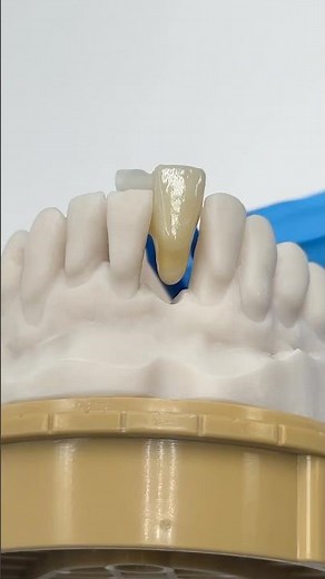Maryland Bridge with a Single Wing #lsk121shorts #dentist #teeth