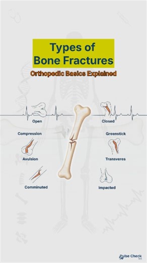 Pulsecheck MD | 🦴 Types of Bone Fractures Explained! 💥 From Open (Compound) to Greenstick, here’s a quick look at the most common types of fractures seen... | Instagram