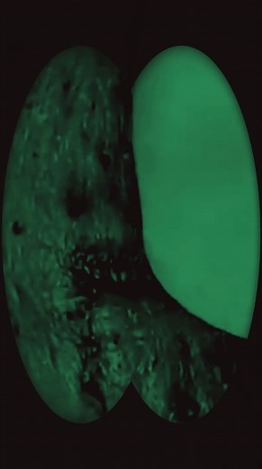 Giant Pimple blackhead Explodes Instantly squeeze acne and Treatment 05(2) | DM6