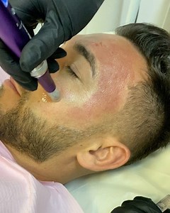 1K views | DERMAPEN + BABY FACE + LASER LUMINA ROȘIE ✔️ Beneficii : stimulează colagenul , tratează semnele cauzate de acnee , porii dilatați , excesul de seboree Preț :200€ Programări :0722296007 | Clinica Beauty Art Aesthetics | Facebook