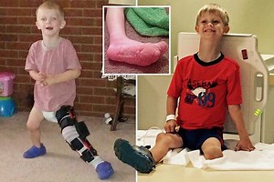 Boy with 'Elephant Man disease' defies odds after being given 1 month to live