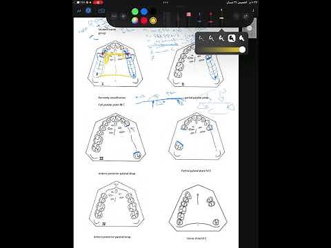 Design of RPD of upper denture