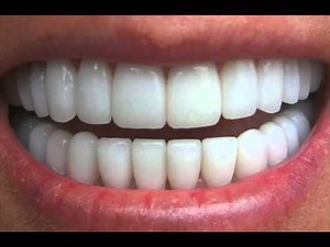 Get Perfectly Straight Teeth ―∎ affirmations | Cure Overbite, Underbite & Crossbite