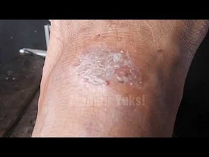 Lihat!! Semut Kerumuni Luka di Kaki. Apakah tanda-tanda Kencing Manis ?