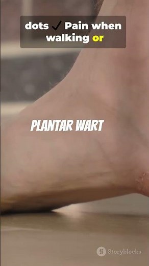 Plantar Warts Explained in 1 Minute | Causes, Symptoms & Treatment