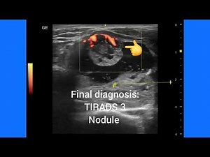 Colloid cyst thyroid with mural nodule, how to analyze, TIRADS Score ultrasound and color Doppler