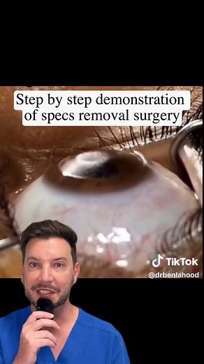 Understanding LASIK Eye Surgery Procedures