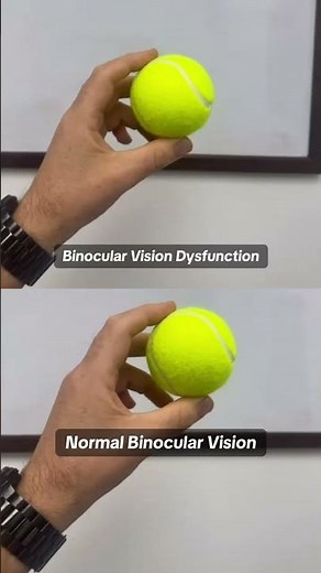 Top: This is what it can look like with Binocular Vision Dysfunction (BVD)—the image from each eye