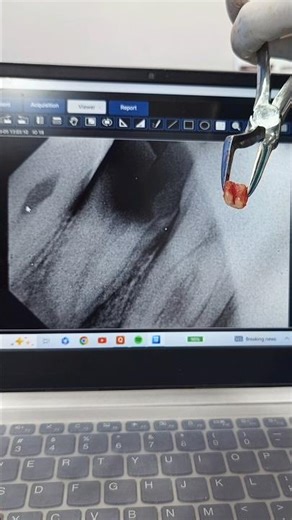 Tooth Extraction Premolar and Molar 💥💪#dentist #drshivamverma #dentaltreatment #shorts