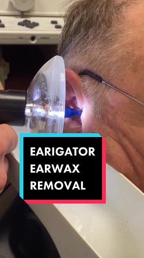 a great earwax transformation with our #earigator! #earwaxremoval #earwax #fyp