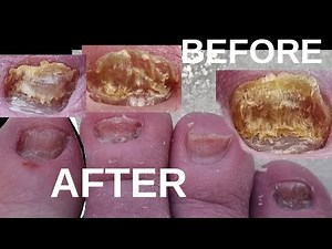 How I grind my toenails: Before and After (DIY grinding pt5)