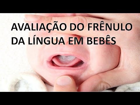 Assessment of the lingual frenulum in infants