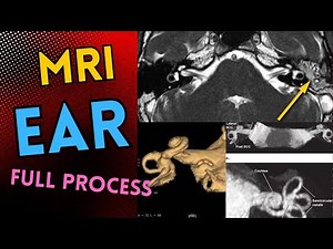 MRI of Ears planning and filming technique full process | SIEMENS |