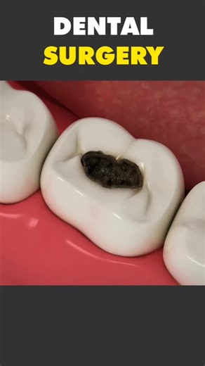 Watch this 3D animation to see how a simple cavity filling can save your tooth! 🦷✨ From removing decay to restoring the tooth’s natural shape, fillings are a quick and effective way to stop cavities from spreading, leaving your smile healthy and strong. 😁 Via: @physioicon Dr.Azimi and His Staff Have Two Locations Ready To Tailor Your Dental Needs 😀 Downtown Las Vegas- (702)-759-0005 📞 Spring Valley Las Vegas- (725)-735-5100 📞 Downtown Las Vegas- 701 E Charleston Blvd, Las Vegas, NV 89104 📍
