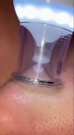 Best Blackhead Removal Tool? Deep Pore Cleansing Device Review & Demo