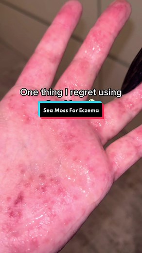 Sea Moss for Eczema Relief