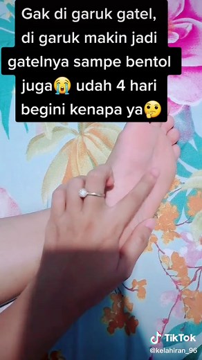 Cara Mengatasi Gatal Di Telapak Kaki Secara Efektif