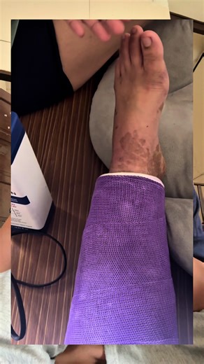 Foot Care Tips After a Leg Cast