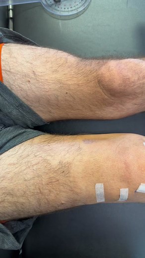 Arthrogenic Muscle Inhibition (AMI) Following ACL-Reconstruction Surgery | Quad Weakness