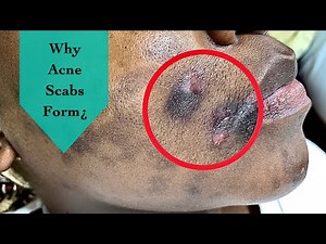 Why Acne Scabs Form¿
