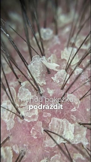 Trápí vás lupy a hledáte péči, která přinese skutečnou úlevu? ❄️