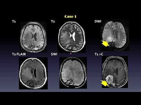 ISMRM MR Academy: 7T ASL Perfusion MRI - Methods and Applications
