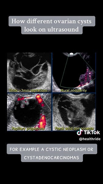 Exploring Ovarian Cysts: Ultrasound Imaging Insights