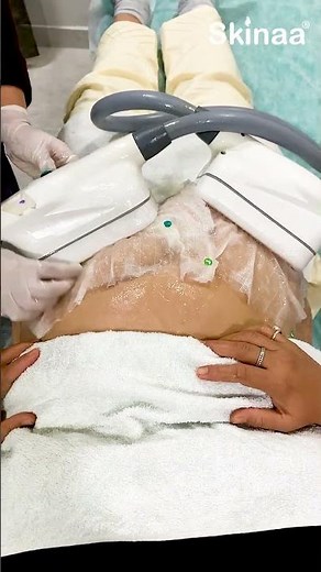 Stubborn Belly Fat? Try Non-Surgical Fat Freezing | Skinaa Clinic #fatfreezing #dermatology