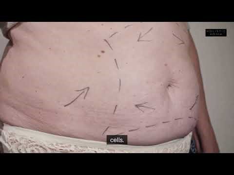 Body Contouring in Tyler, TX: See Real Before & After Changes