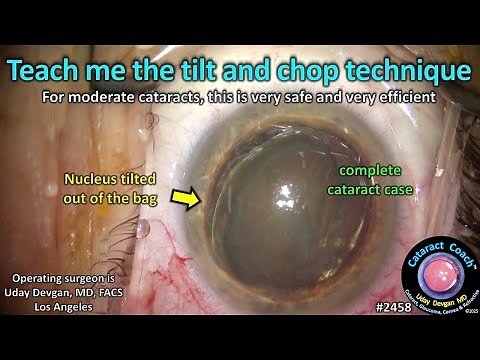 CataractCoach™ 2458: teach me the tilt and chop technique for phaco